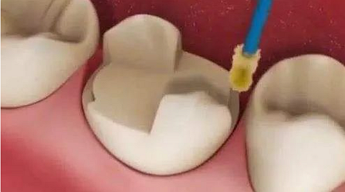 妙手牙醫丨殘根、殘冠還有保留的意義嗎？