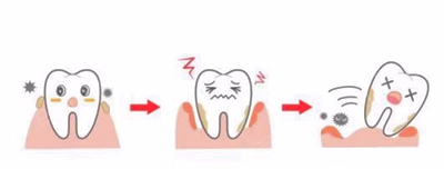 牙周病總是來勢洶洶？有辦法預(yù)防嗎？